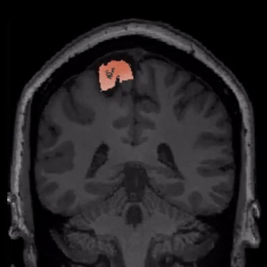 Cortical deviation mapping showing lesion detection in MRI-negative epilepsy case