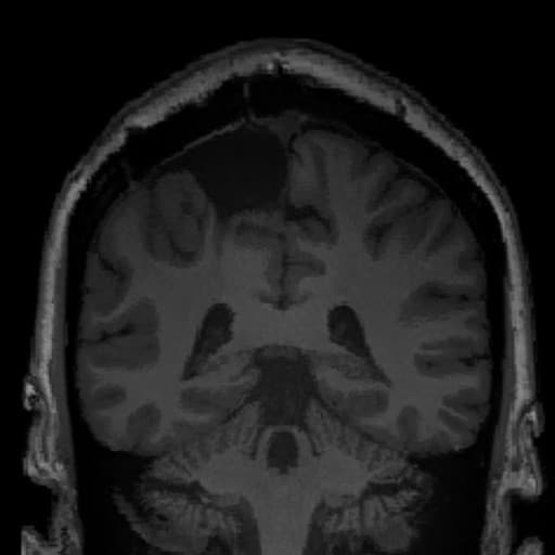 MRI scan showing post-surgical changes following epilepsy treatment