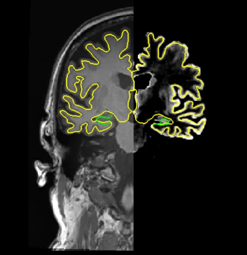 Brain MRI showing age-related global atrophy