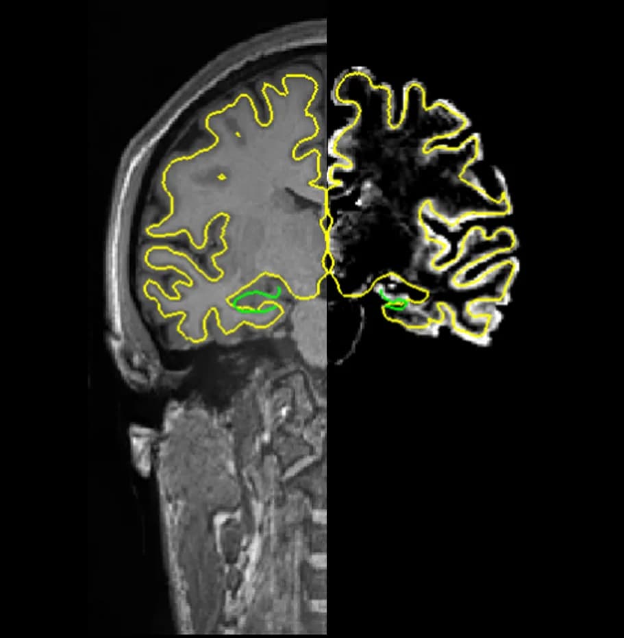 Brain MRI showing right hippocampal atrophy