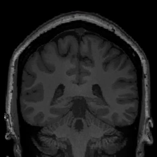 MRI-NEGATIVE